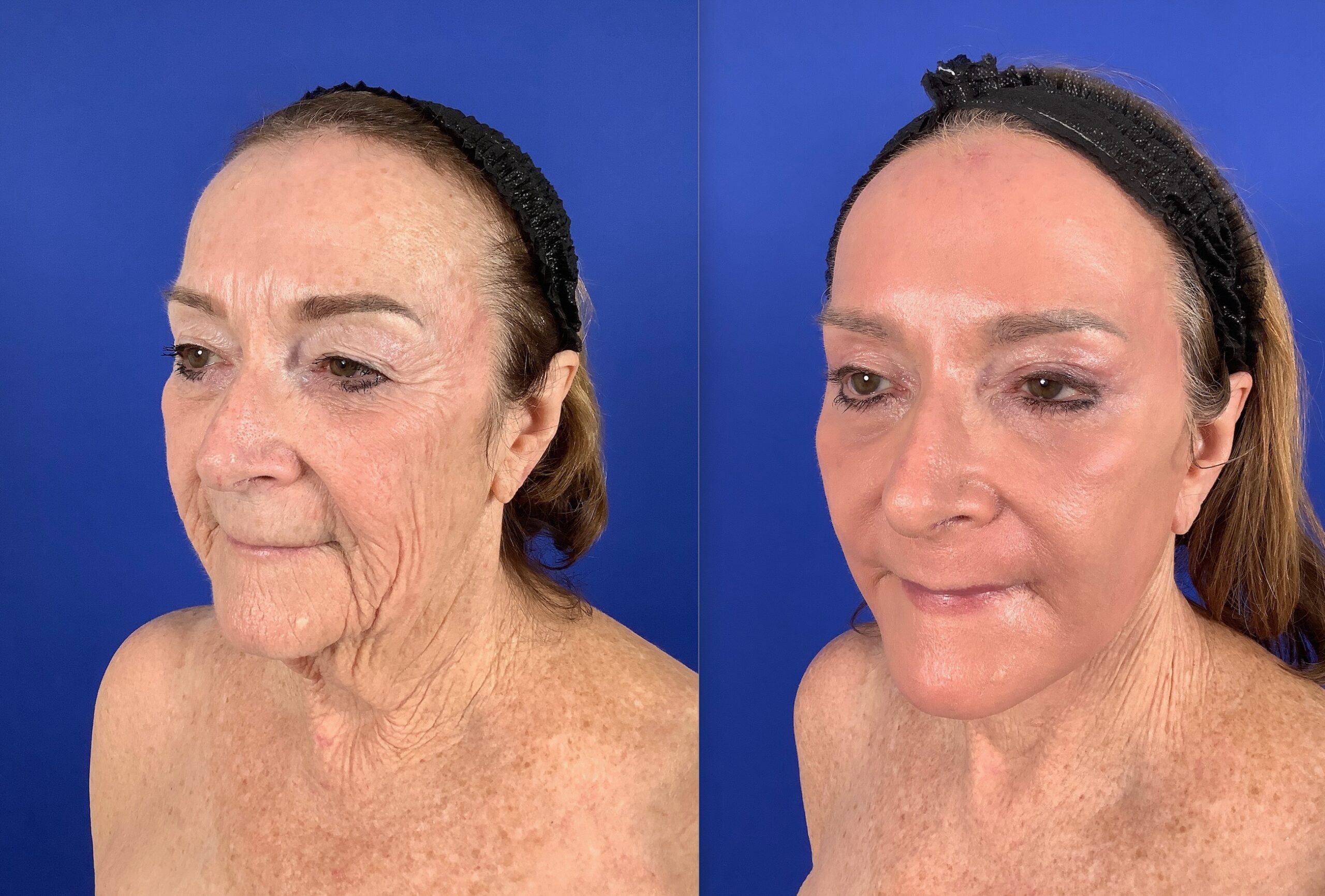 Before and after results of a Croton Oil Peel showing significant improvement in wrinkles, skin texture, and overall facial rejuvenation.
